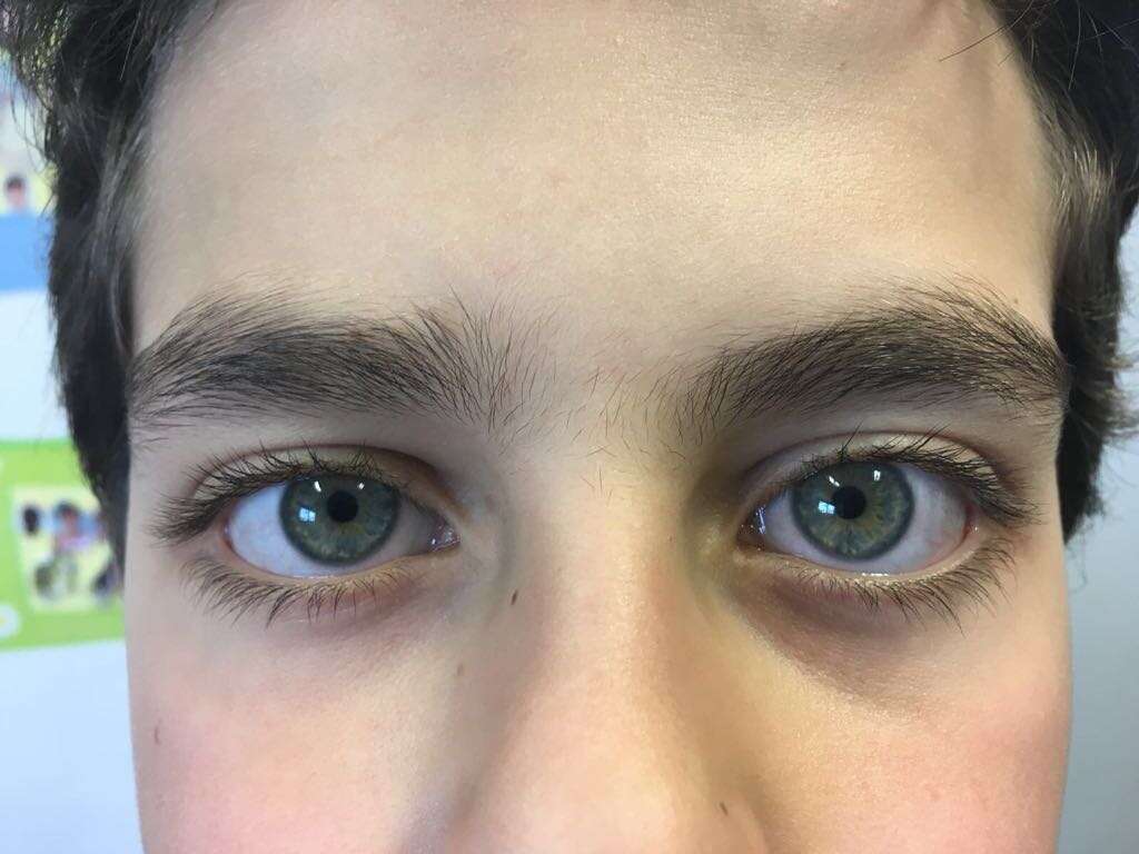 Figure 2. Symmetrical pupils 48 hours after initial examination. 